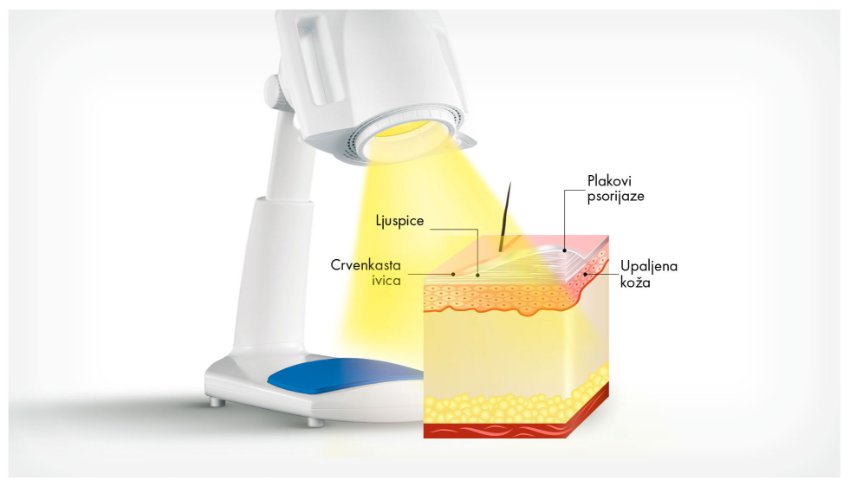 KLINIČKO ISTRAŽIVANJE POTVRĐUJE: BIOPTRON® HIPERSVETLOSNA TERAPIJA ZNAČAJNO UBLAŽAVA SIMPTOME PSORIJAZE