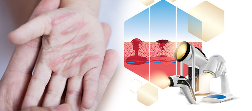 BIOPTRON® HIPERSVETLOST JE ZNATNO  EFIKASNIJA OD TERAPIJE LASEROM NISKOG INTENZITETA, POKAZUJE NOVO KLINIČKO ISPITIVANJE